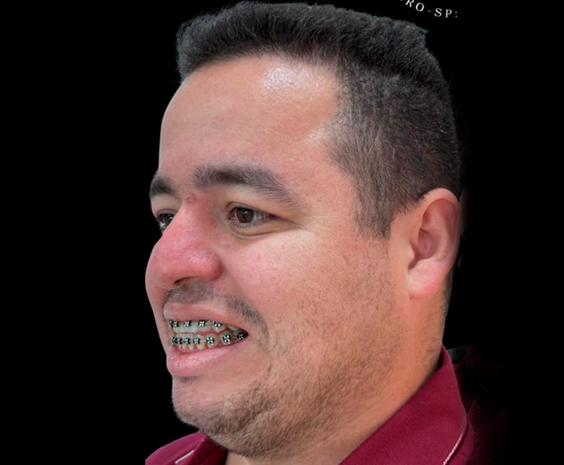 Antes da cirurgia ortognática com lipo de papada