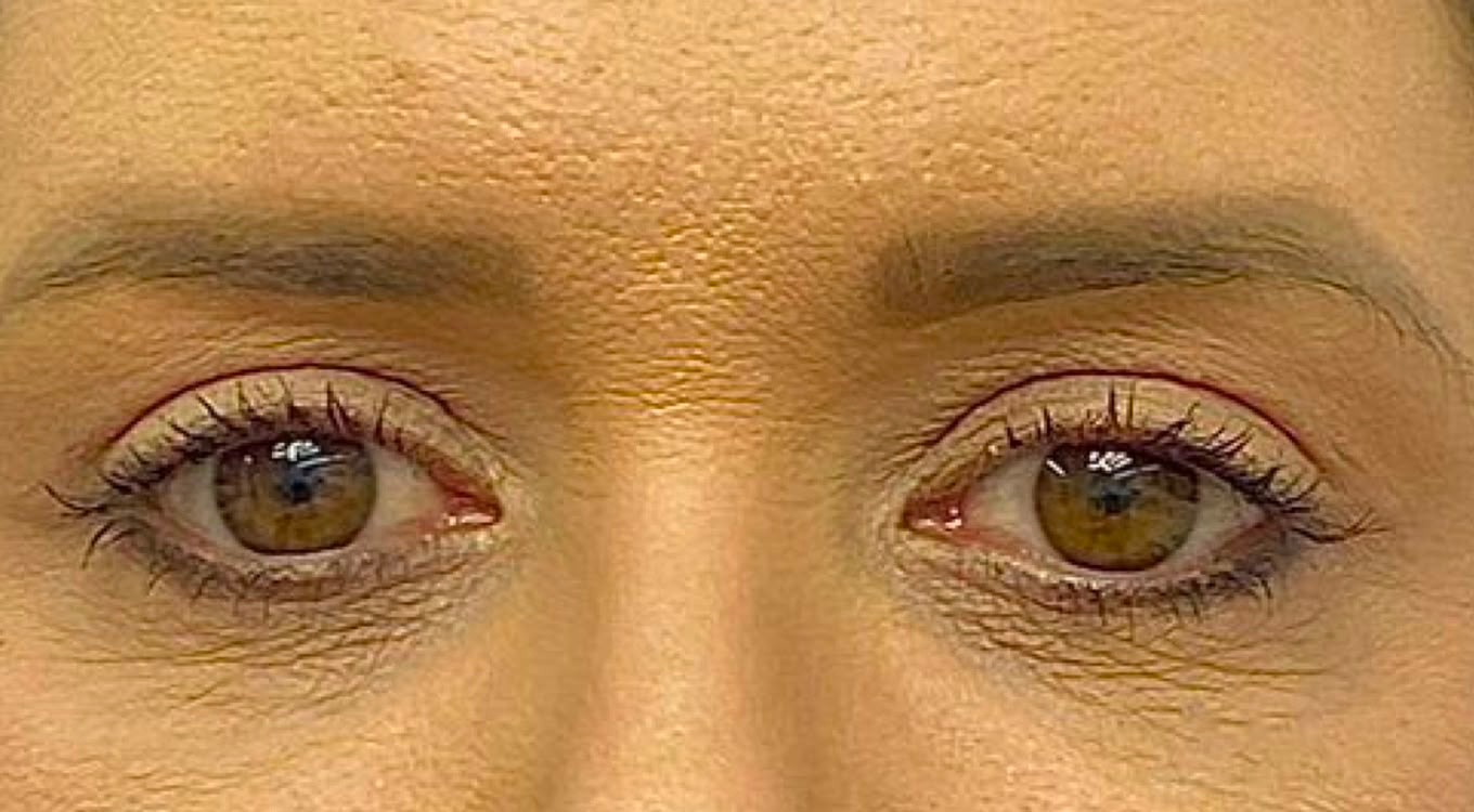 Depois da blefaroplastia