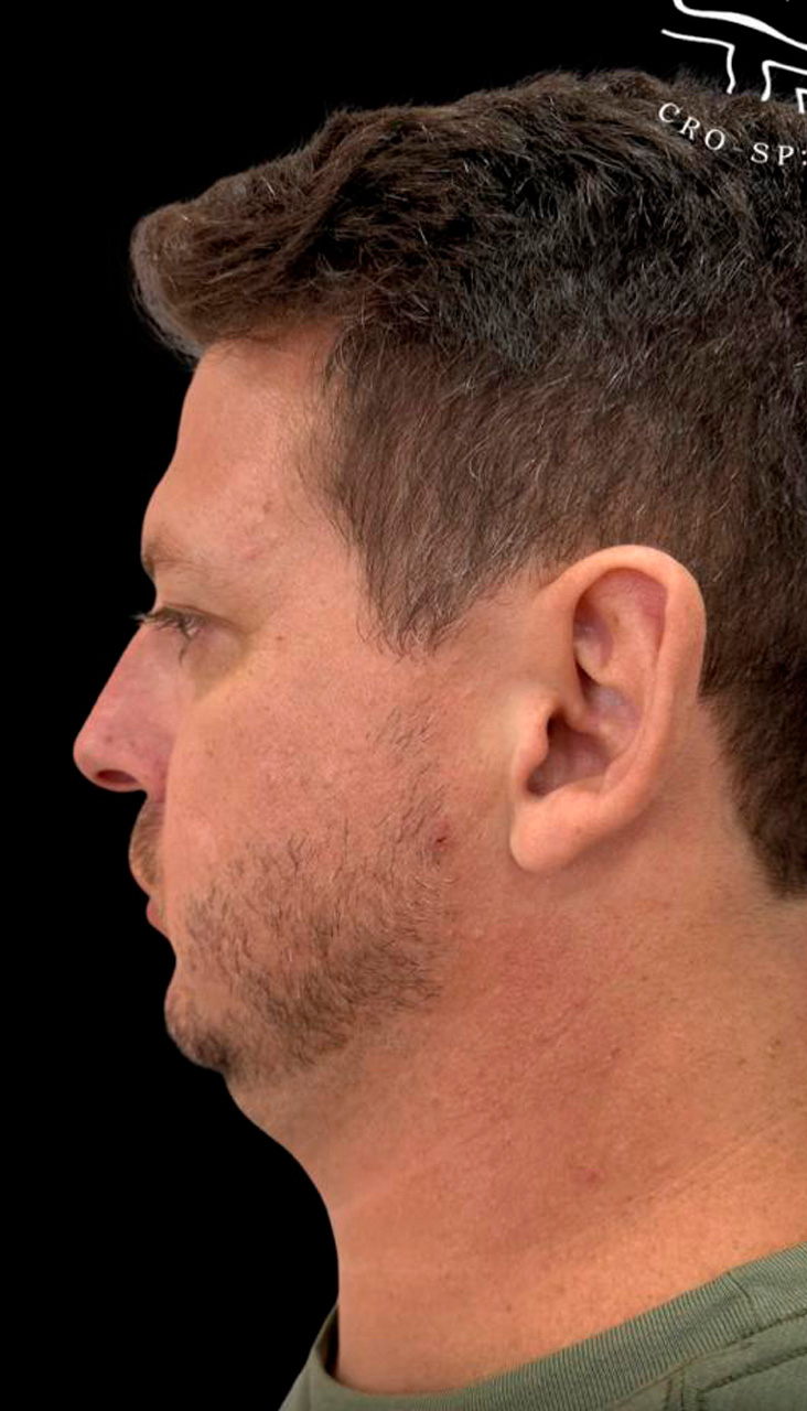 Antes do tratamento ortognático e de apneia do sono