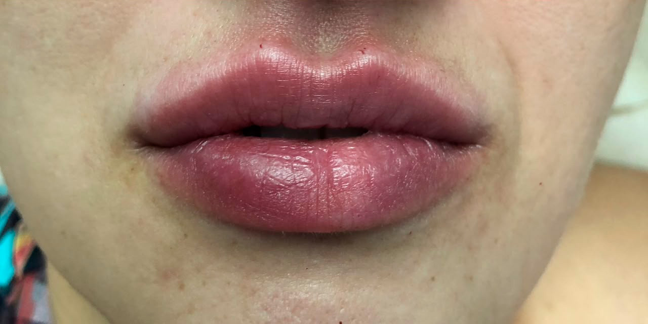 Depois do preenchimento labial