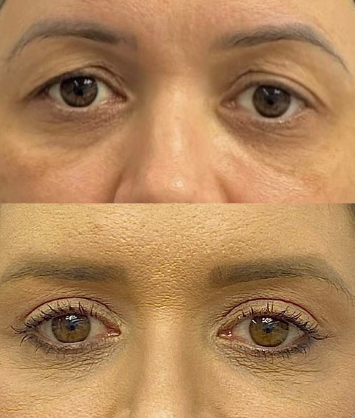 Caso Clínico — Blefaroplastia