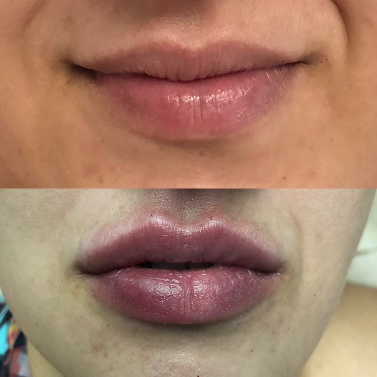 Caso Clínico — Harmonização Facial